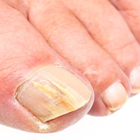 Fungal nails